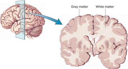 gray matter loss in schizophrenia