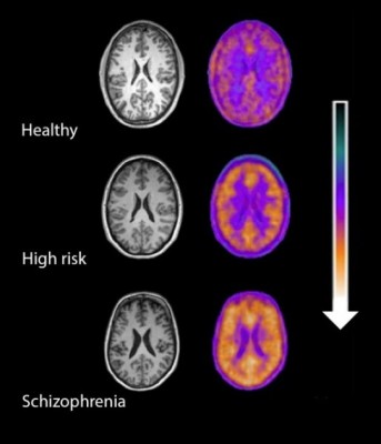 brain inflammation in schizophrenia