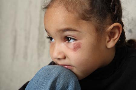 child with bruised face